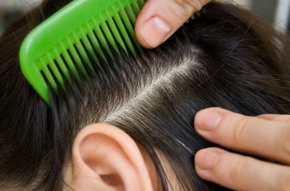 Naikindami galvines utėles gyventojai stebina išradingumu