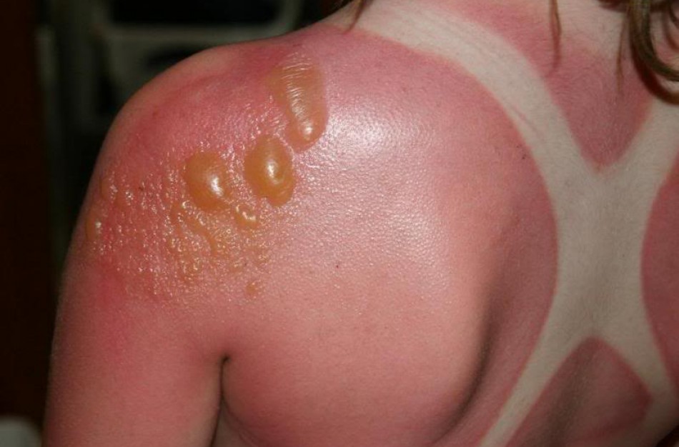 Nudegimo saulėje pasekmes galite jausti net pusmetį