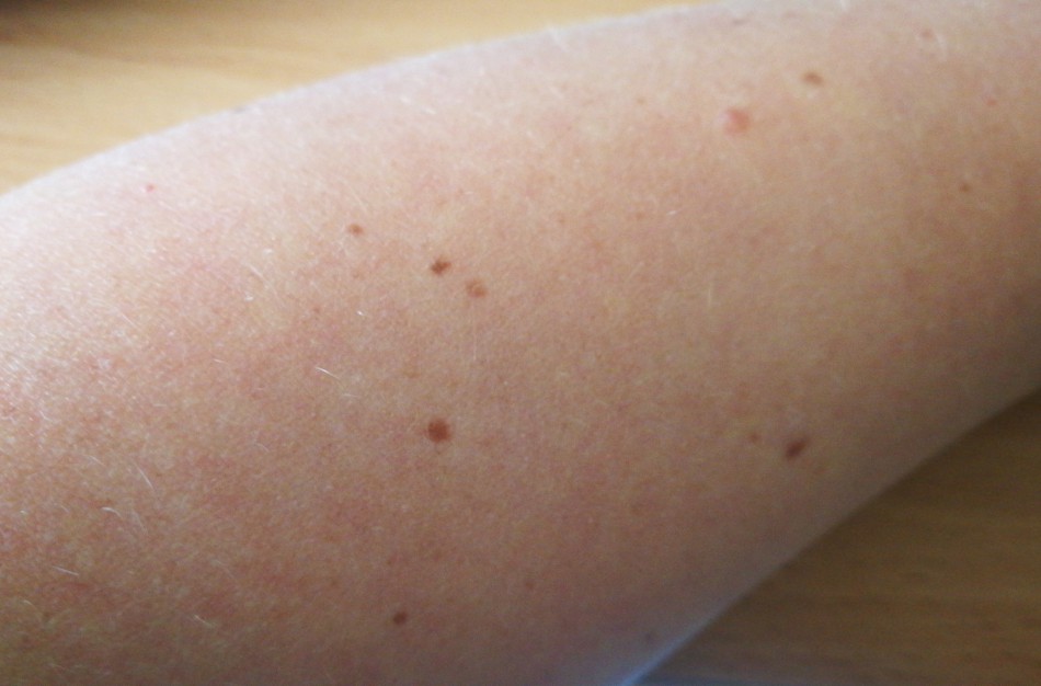 Saulė išryškino apgamus: kada dėl jų reikėtų sunerimti?