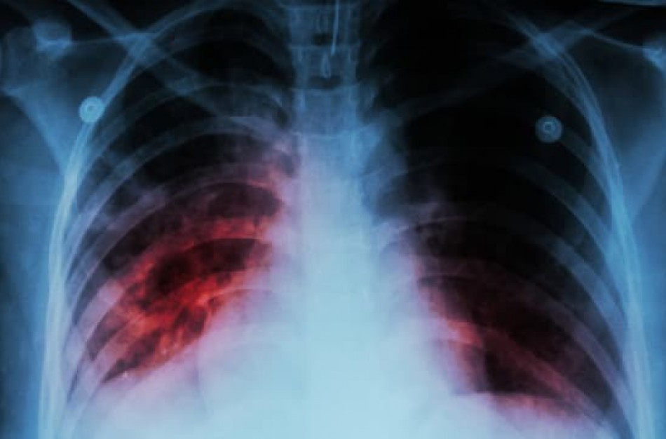 Tuberkuliozė – ne tik asocialių asmenų liga