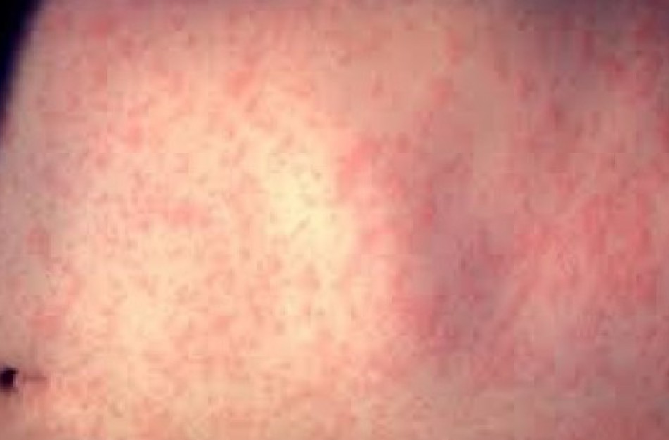 Jonavoje registruoti penki susirgimų tymais atvejai