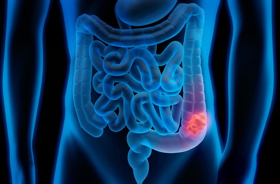 Kolorektalinis vėžys: gerai užsimaskavusi liga, apie kurią kalbėti būtina