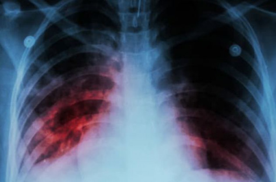 ,,Laikrodis tiksi‘‘ – Pasaulinė tuberkuliozės diena  