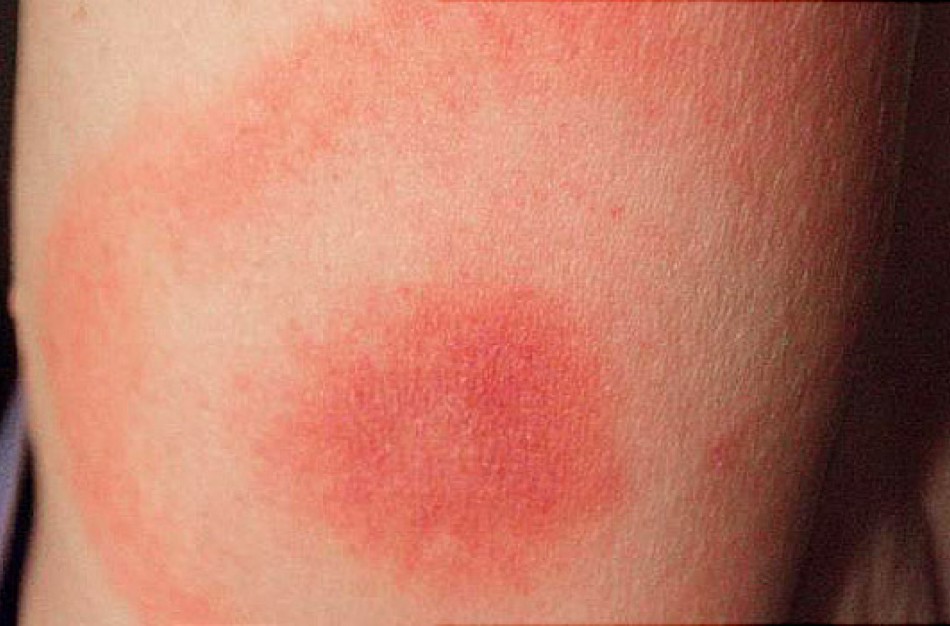 Atšilus orams, atsibudo ir erkės