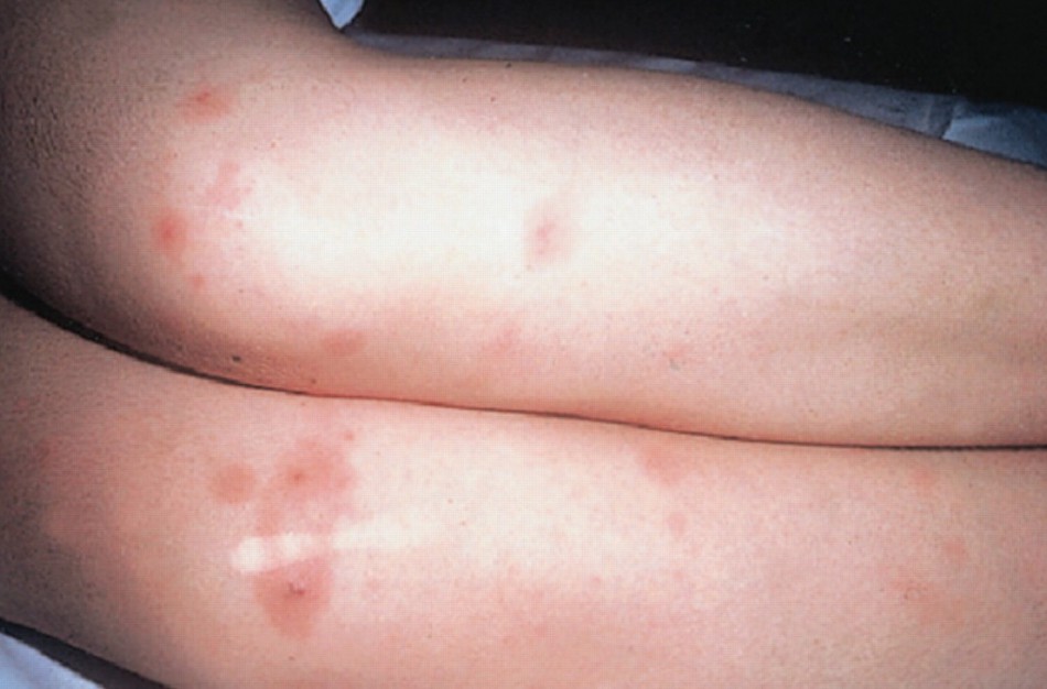 ULAC: Reikšmingai padidėjo vaikų skiepijimai nuo meningokokinės infekcijos