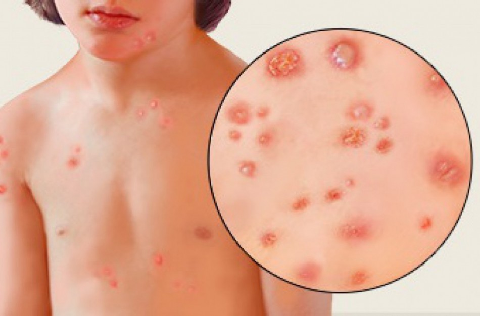 Vėjaraupiai - ar galima apsisaugoti?