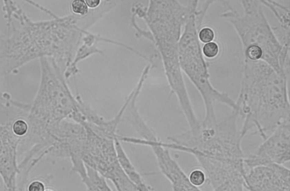 Paslaptingieji eozinofilai: kaip juos suvaldyti sergant astma