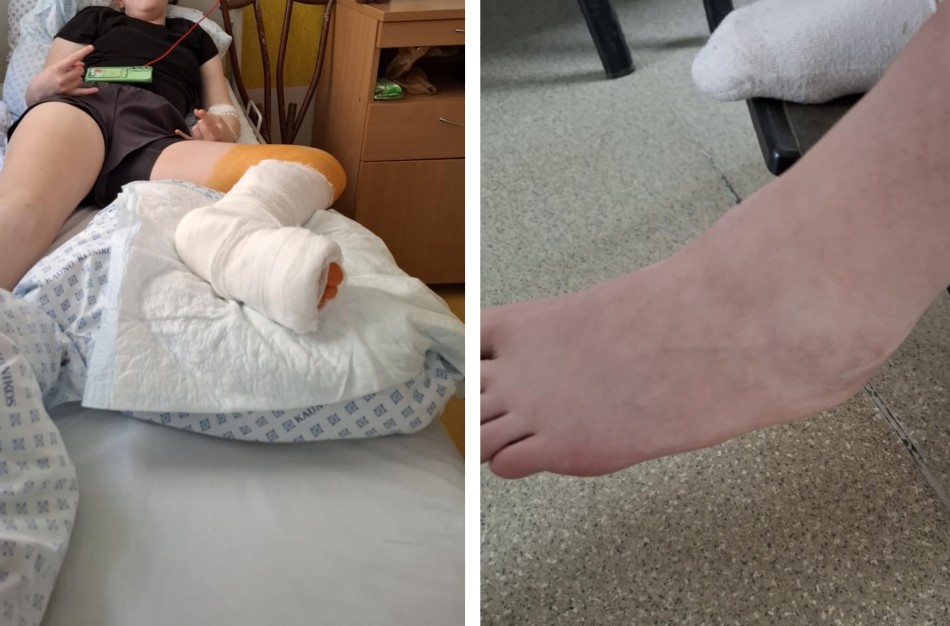 Trylikametės jonavietės kojos lūžis nepastebėtas Jonavoje, operuotas Kaune
