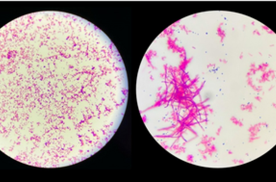 Tuberkuliozė: grėsmė gyvybei, kuri įveikiama pasitelkiant pažangią diagnostiką