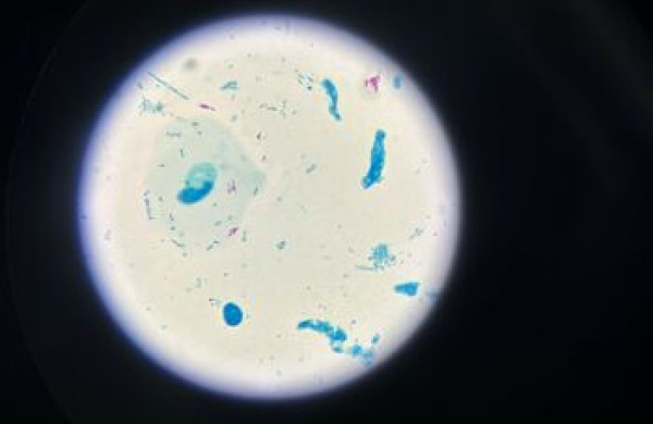 Tuberkuliozė: grėsmė gyvybei, kuri įveikiama pasitelkiant pažangią diagnostiką